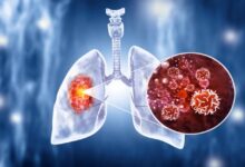 Lung Cancer Treatment