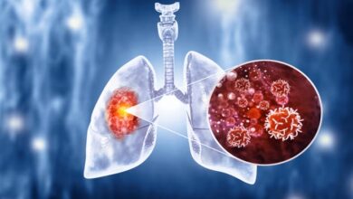 Lung Cancer Treatment