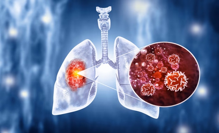Lung Cancer Treatment